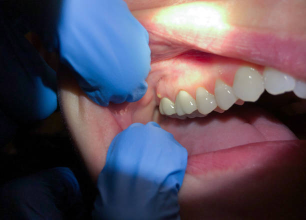 Best Emergency Treatment for Dental Infections or Abscesses in Franklin Farm, VA